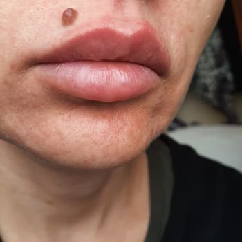 Procsin 3 Complex Solution Cildimi Mahvetti.