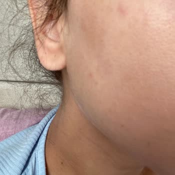 Loreal Yüz Temizleme Jeli Yüzümü Mahvetti