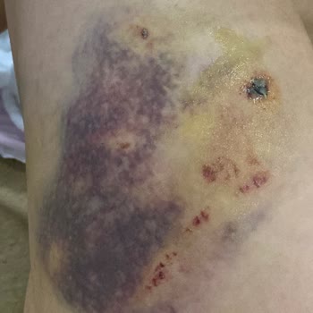 İBB - İstanbul Büyükşehir Belediyesi Köpek Saldırısına Uğradım