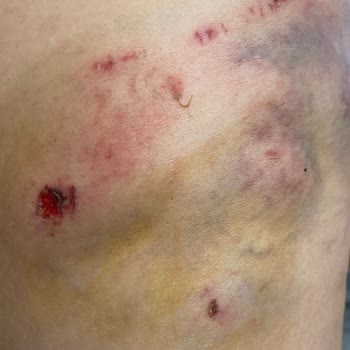 İBB - İstanbul Büyükşehir Belediyesi Köpek Saldırısına Uğradım