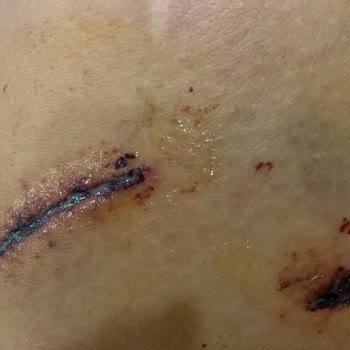 İBB - İstanbul Büyükşehir Belediyesi Köpek Saldırısına Uğradım