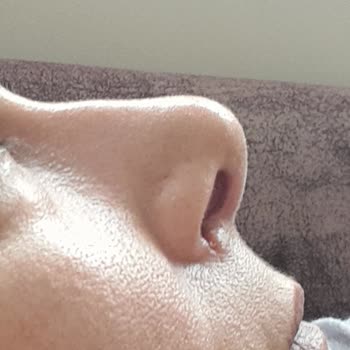 Op. Dr. Serdar Ünlü Rinoplasti Pişmanlığım!