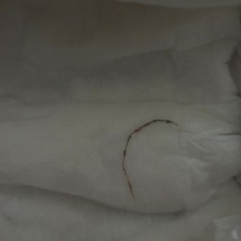 Baby Turco Bebek Bezinde Yabancı Madde