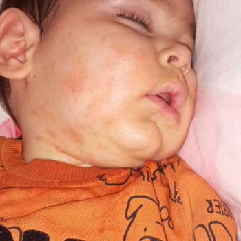 Bioderma Atoderm Krem Alerji Yaptı