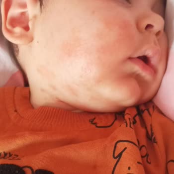 Bioderma Atoderm Krem Alerji Yaptı