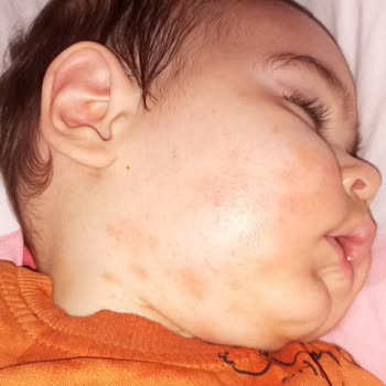 Bioderma Atoderm Krem Alerji Yaptı