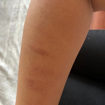 Rosso Beauty Halkalı (Güzellik Merkezi) Kolum Lazer İşleminde Yandı.