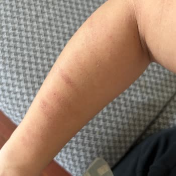 Rosso Beauty Halkalı (Güzellik Merkezi) Kolum Lazer İşleminde Yandı.