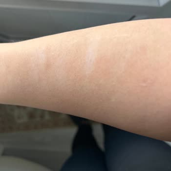 Rosso Beauty Halkalı (Güzellik Merkezi) Kolum Lazer İşleminde Yandı.