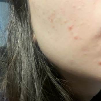 Nivea Cilt Bakım Serumu Kullanımından Kaynaklanan Yan Etkiler