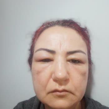 Jeuvenile C Vitaminli Krem Beni Hastanelik Etti