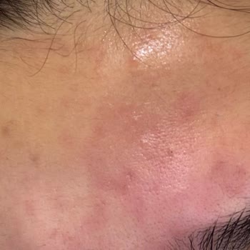 La Roche - Posay Serum Yanma Yaptı