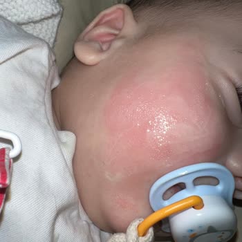 Mustela Stelatopia Krem Bebeğimi Yaktı