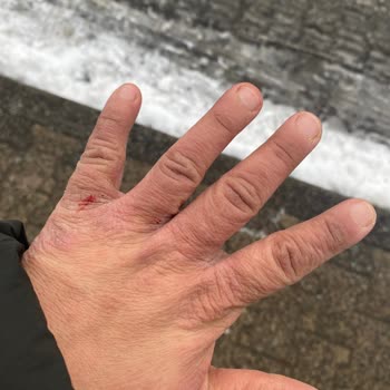 Pril Bulaşık Deterjanı Ellerimi Çürüttü