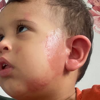 Berko İlaç İburamın Zero Mağduru Olduk