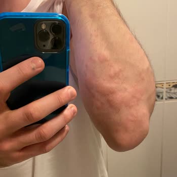 HIQ Nutrition Hıq Gain Deluxe Alerji Kaşıntı Ve Kabarıklık