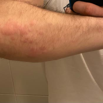 HIQ Nutrition Hıq Gain Deluxe Alerji Kaşıntı Ve Kabarıklık