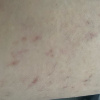 İdea Klinik İzmir Varis Tedavisi