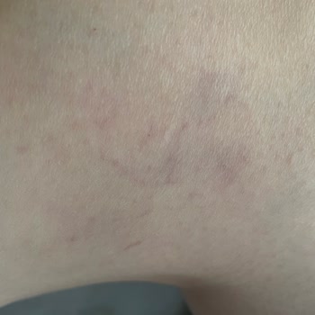 İdea Klinik İzmir Varis Tedavisi