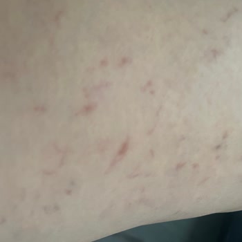 İdea Klinik İzmir Varis Tedavisi