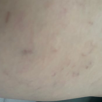 İdea Klinik İzmir Varis Tedavisi