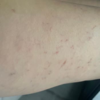 İdea Klinik İzmir Varis Tedavisi