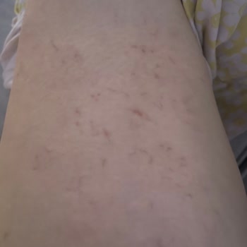 İdea Klinik İzmir Varis Tedavisi