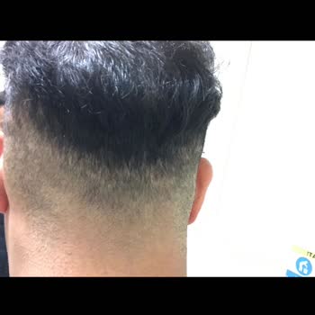 Gold City Hair İstanbul Saç Ekimi Sonrası Donör Alanındaki İzler