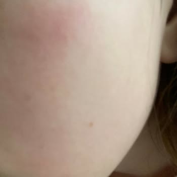 Watsons Maske Alerji Yaptı