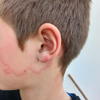 Paranit İlacı Alerji Yaptı