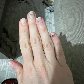 Prothesennägel-Desaster und bakterielle Infektion bei Büşra Yıldız Beauty