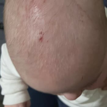 Atopische Reaktionen mit Mustela Stelatopia Körperlotion