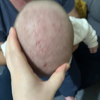 Atopische Reaktionen mit Mustela Stelatopia Körperlotion