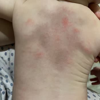 Atopische Reaktionen mit Mustela Stelatopia Körperlotion