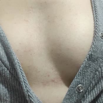 Allergische Reaktion während der Schwangerschaft auf Mustela Creme