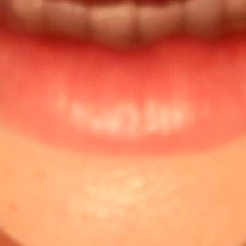 Estrella Medical Group Erimeyen Dudak Dolgusu