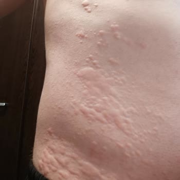 MHRS Kurdeşen Hastalığına Yakalandım Randevu Alamıyorum