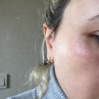 Loreal Paris L'Oreal Retinol Kullanımı Sonrası Yaşadığım Cilt Sorunu