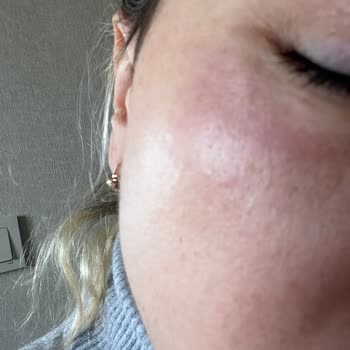 Loreal Paris L'Oreal Retinol Kullanımı Sonrası Yaşadığım Cilt Sorunu