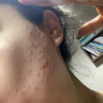 Lady Legant Beauty Epilasyon Sonrası Yüzüm Mahvoldu!