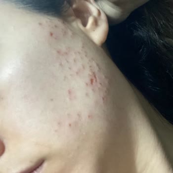 Lady Legant Beauty Epilasyon Sonrası Yüzüm Mahvoldu!