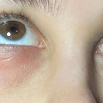 Estee Lauder Eye Gel-creme Egzama Yaptı