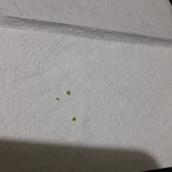 Eker Kefirden Çıkan Yabancı Madde