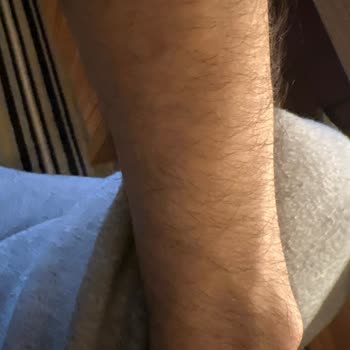 Yaka Estetik (Nişantaşı) Nişantaşı'nda Epilasyon Sonrası Beklenmedik Sonuçlar