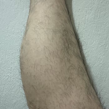 Arlina Estetik Eskisinden Daha Çok Kıllarım Çıkıyor