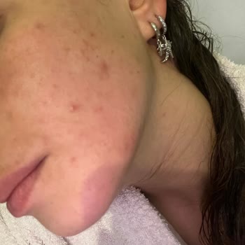 Beauty Boss Dermapenden Sonra Sivilce Hüsranı