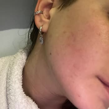 Beauty Boss Dermapenden Sonra Sivilce Hüsranı