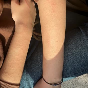 Selin Beauty Center Güzellik Merkezi Seans Sonrası Laser Yanığı