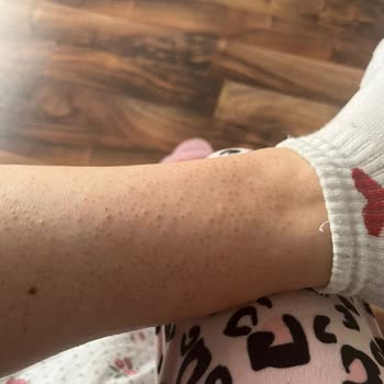 Selin Beauty Center Güzellik Merkezi Seans Sonrası Laser Yanığı