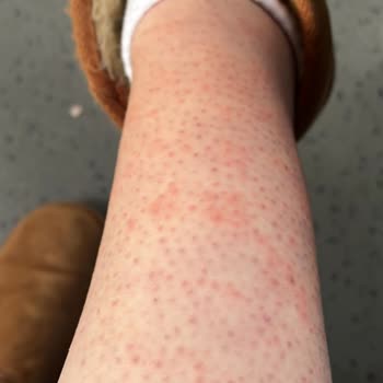 Selin Beauty Center Güzellik Merkezi Seans Sonrası Laser Yanığı